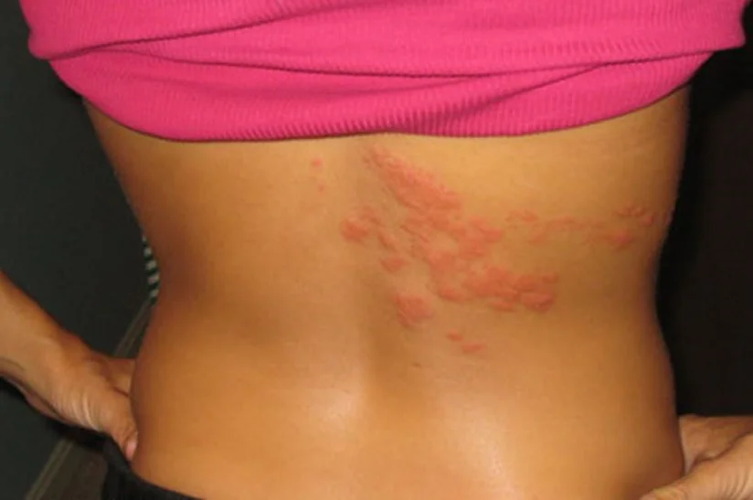 Як виглядають перші симптоми герпесу на тілі