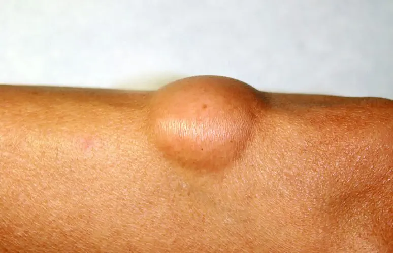 Коли потрібно видаляти ліпому