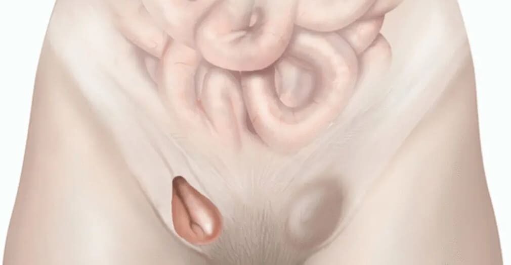 Чому грижа виникає: історії з досвіду чоловіків