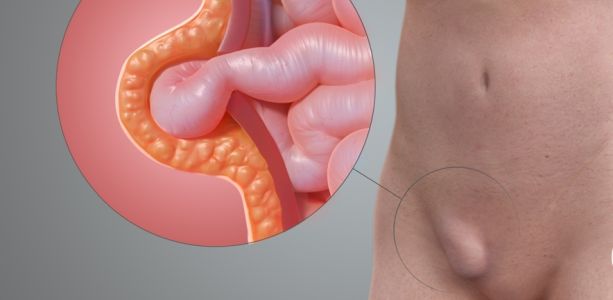 Якщо грижу не лікувати