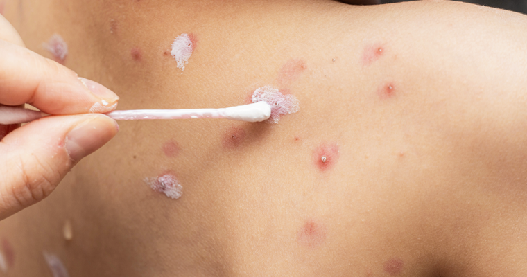 Лікування герпесу на тілі: що справді працює